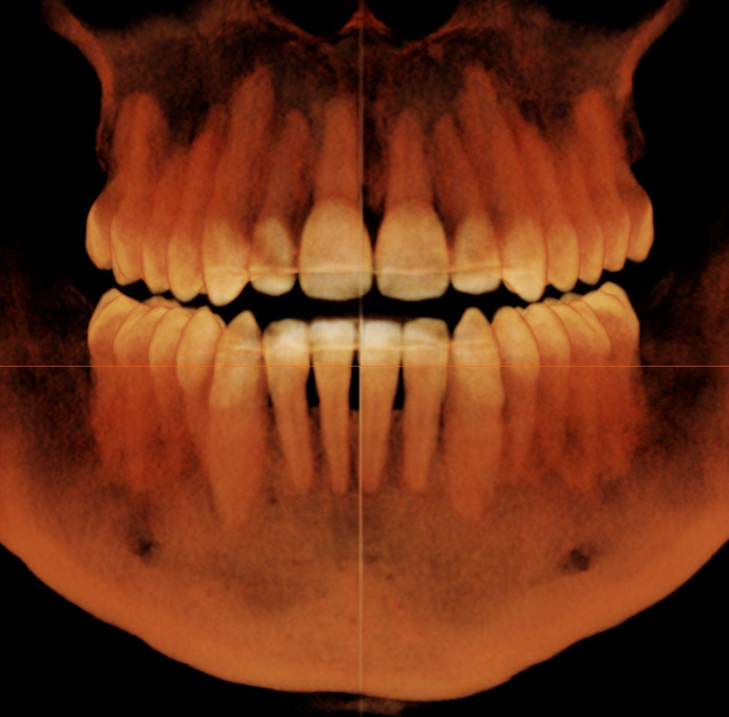 Cone Beam CT volume rendering of the teeth and jaws